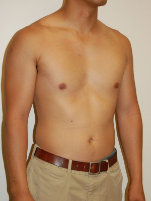 Male Pectoral Implants