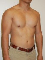 Male Pectoral Implants