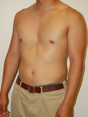 Male Pectoral Implants