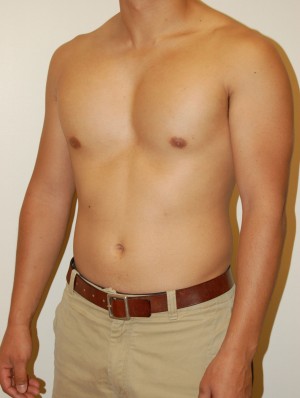 Male Pectoral Implants