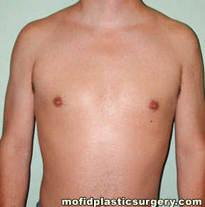 Male Pectoral Implants Case 4872 Before Photo Male Pectoral Implants
