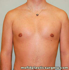 Male Pectoral Implants Case 4872 After Photo Male Pectoral Implants