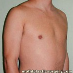 Male Pectoral Implants