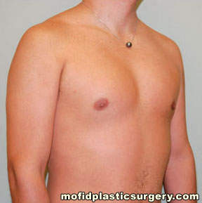 Male Pectoral Implants Case 4872 After Photo Male Pectoral Implants