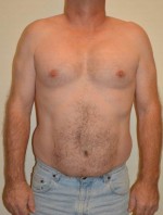 Male Pectoral Implants