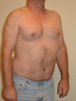 Male Pectoral Implants Case 4880 After Photo Male Pectoral Implants