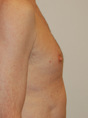 Nipple Reduction Case 4772 Before Photo Nipple Reduction