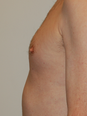 Nipple Reduction Case 4772 Before Photo Nipple Reduction