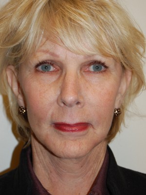 Facial Fat Grafting Case 4892 After Photo Facial Fat Grafting