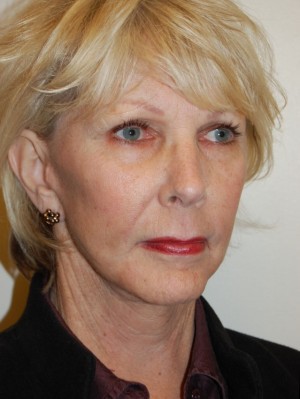 Facial Fat Grafting Case 4892 After Photo Facial Fat Grafting