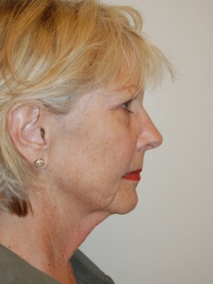 Facial Fat Grafting Case 4892 Before Photo Facial Fat Grafting