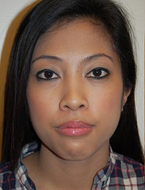 Chin Implants Case 4937 Before Photo Chin Implants
