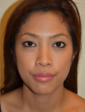 Chin Implants Case 4937 After Photo Chin Implants