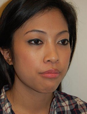 Chin Implants Case 4937 Before Photo Chin Implants
