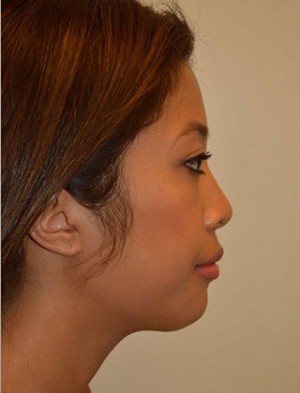 Chin Implants Case 4937 After Photo Chin Implants