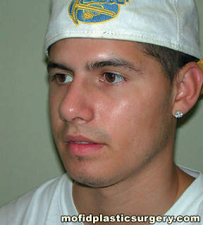 Chin Implants Case 4945 After Photo Chin Implants