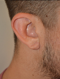 Earlobe Reduction Case 4959 After Photo Earlobe Reduction