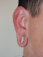 Earlobe Reduction