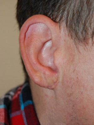 Earlobe Reduction