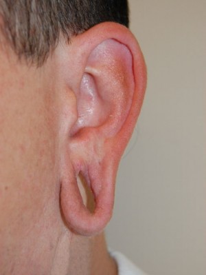 Earlobe Reduction