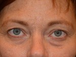 Eyelid Surgery