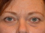 Eyelid Surgery