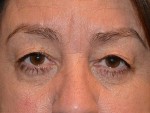 Eyelid Surgery