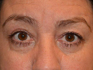 Eyelid Surgery Case 4970 After Photo Eyelid Surgery