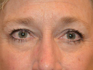 Eyelid Surgery Case 4975 Before Photo Eyelid Surgery