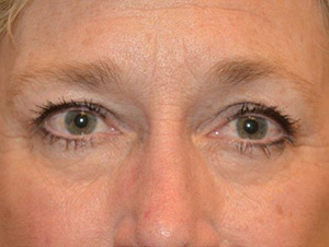 Eyelid Surgery