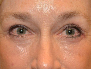 Eyelid Surgery Case 4975 After Photo Eyelid Surgery