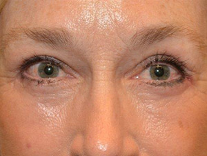 Eyelid Surgery