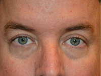Eyelid Surgery Case 4981 After Photo Eyelid Surgery