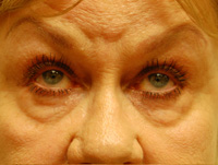 Eyelid Surgery Case 4985 Before Photo Eyelid Surgery