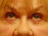 Eyelid Surgery Case 4985 After Photo Eyelid Surgery