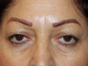Eyelid Surgery Case 4993 Before Photo Eyelid Surgery