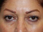 Eyelid Surgery