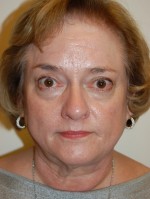 Facelift and Necklift