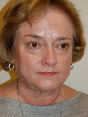 Facelift and Necklift Case 4997 Before Photo Facelift and Necklift