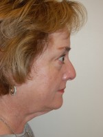 Facelift and Necklift