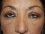 Eyelid Surgery