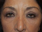 Eyelid Surgery