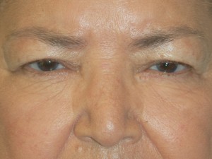 Eyelid Surgery Case 5025 Before Photo Eyelid Surgery