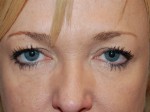 Eyelid Surgery