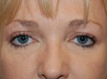 Eyelid Surgery
