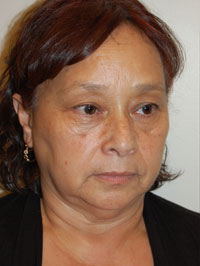 Facial Fat Grafting Case 5104 Before Photo Facial Fat Grafting