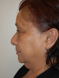 Facial Fat Grafting Case 5104 Before Photo Facial Fat Grafting