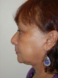 Facial Fat Grafting Case 5104 After Photo Facial Fat Grafting
