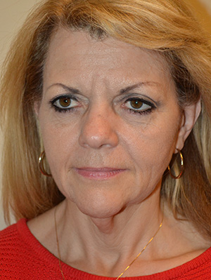Facelift and Necklift Case 5002 Before Photo Facelift and Necklift
