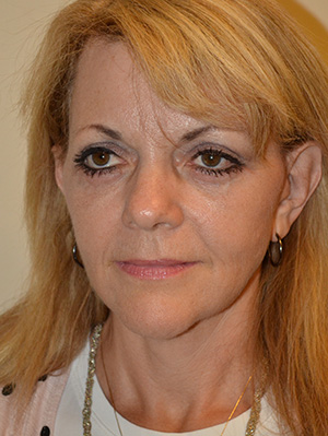 Facelift and Necklift Case 5002 After Photo Facelift and Necklift